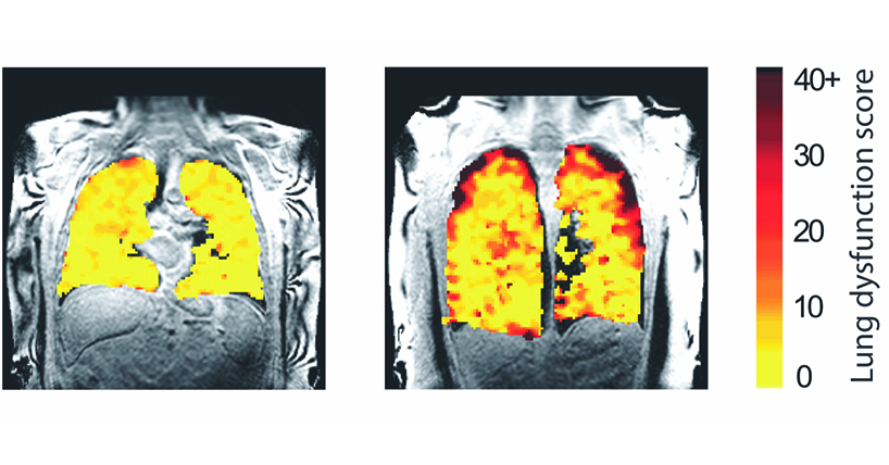 A scan of lungs highlighting in colour where air is travelling to